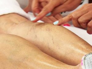tratamientos-naturales-para-eliminar-varices-en-las-piernas