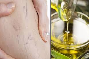 aceite de oliva para las varices