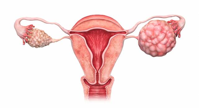 Síntomas del cáncer de ovarios 
